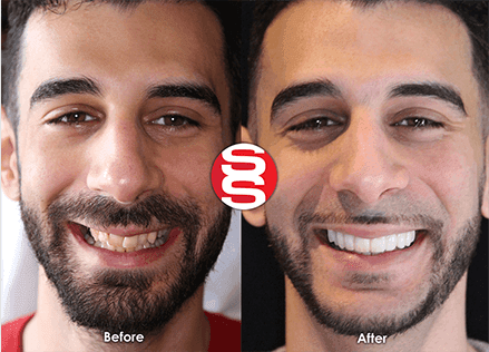 Porcelain Veneers